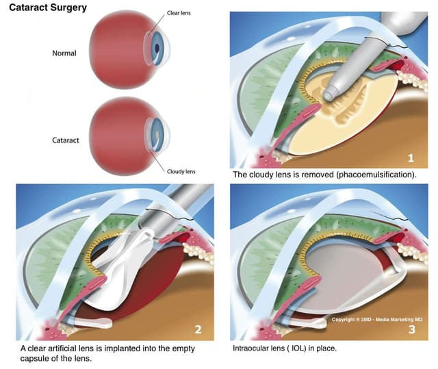 Cataract